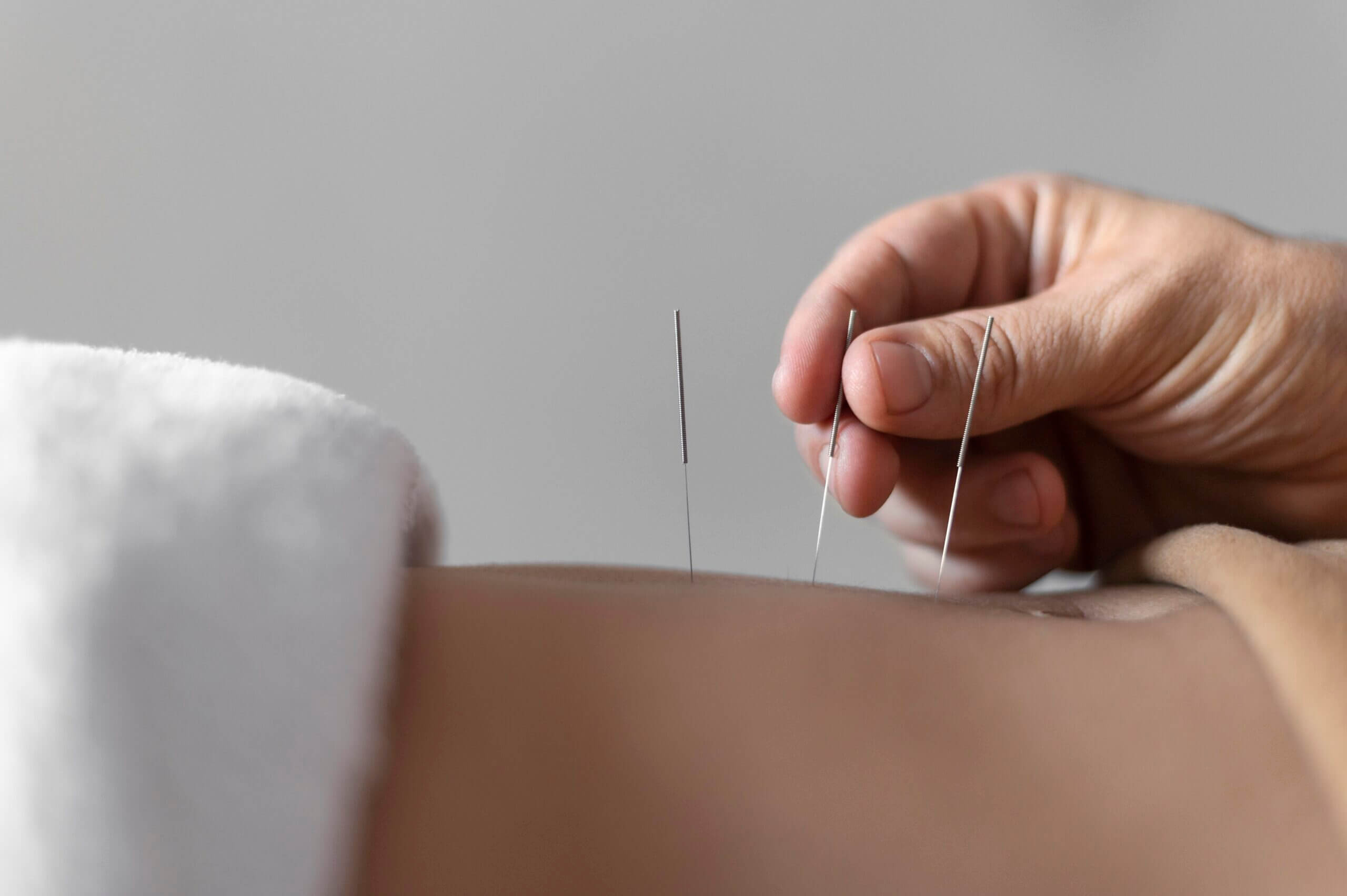Dry needling being applied in skin